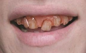 Hillybilly Redneck Veneer Teeth Fake False Dentures