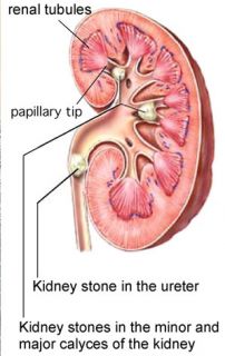 KidneMax   STONE BREAKER Herbal Kidney Support Relieves Pain, Top